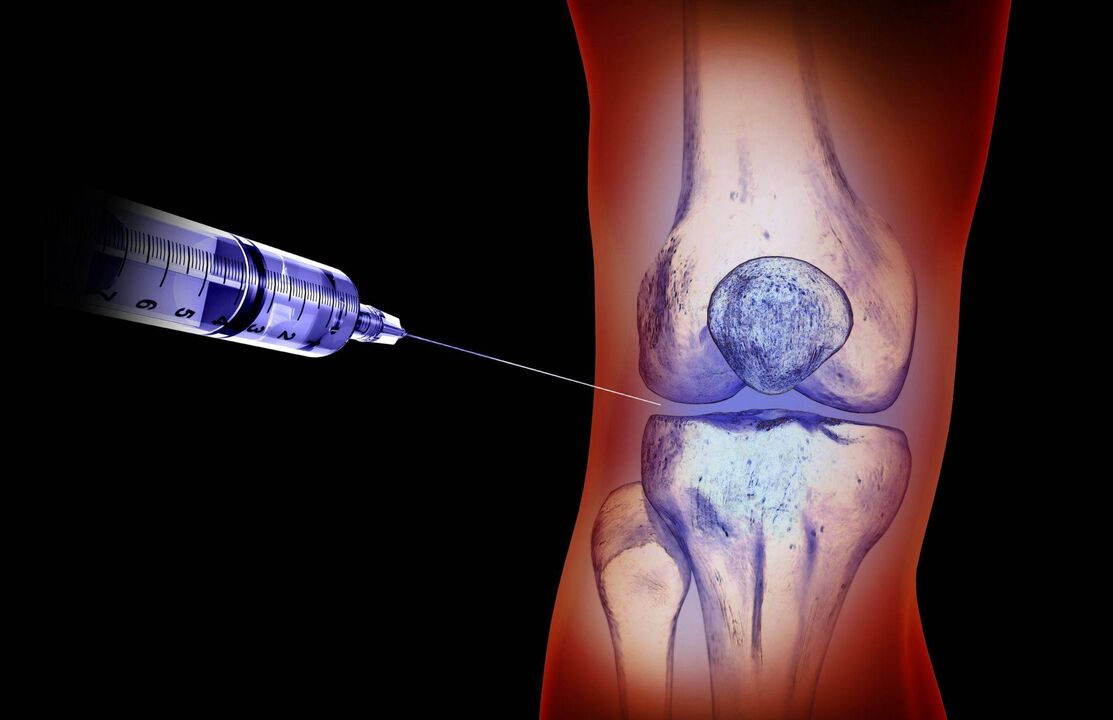 werohanga-a-roto mo te arthrosis