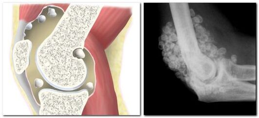 chondromatosis me te mamae i roto i te hononga hip
