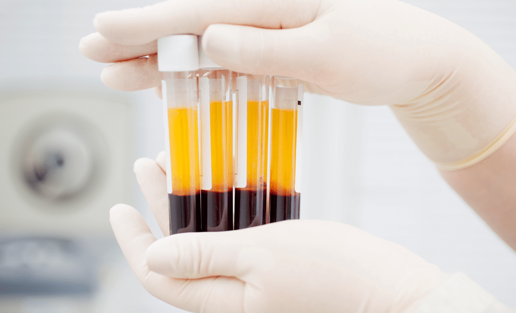 Platelet-taonga plasma mo te rongoa PRP mo te arthrosis