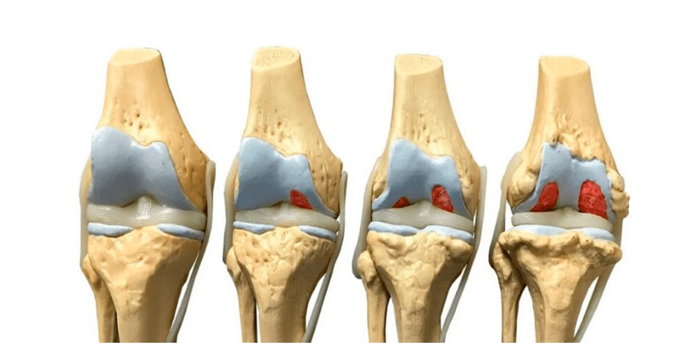 tohu o te arthrosis o nga hononga